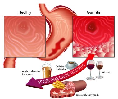 symptoms of gastritis and foods to avoid clipart