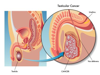 Medical Illustration of the effects of testicular cancer clipart