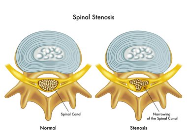Medical illustration of the effects of spinal stenosis clipart
