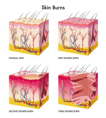 Medical illustration of the formation of skin burns clipart
