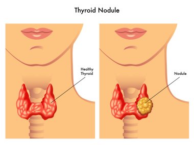Medical illustration of the effects of the thyroid cancer clipart