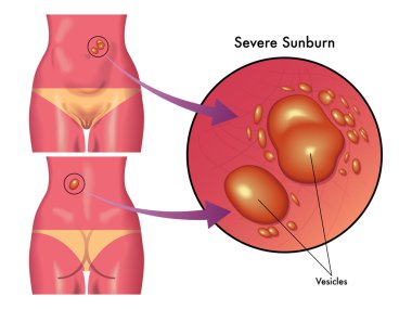 Şiddetli güneş yanığının sonuçlarının tıbbi çizimi
