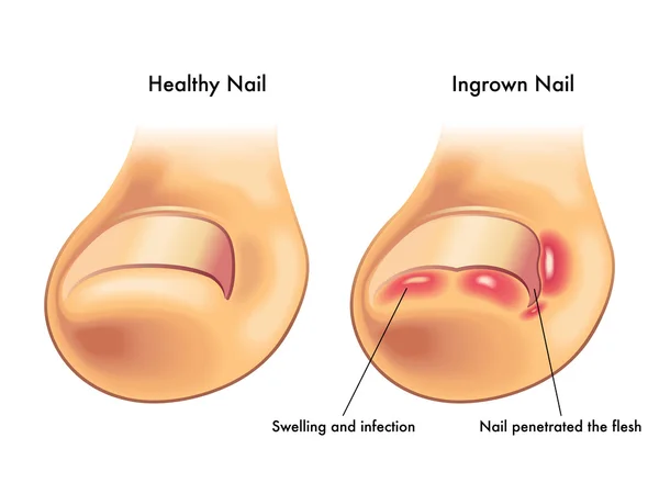 Medizinische Illustration der Symptome eines eingewachsenen Nagels — Stockvektor