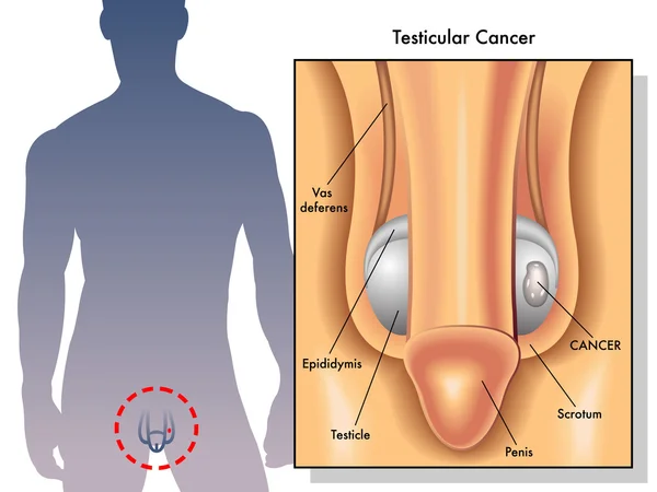 Ilustração médica dos efeitos do câncer testicular — Vetor de Stock