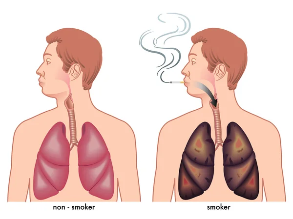 Illustrazione degli effetti del fumo — Vettoriale Stock