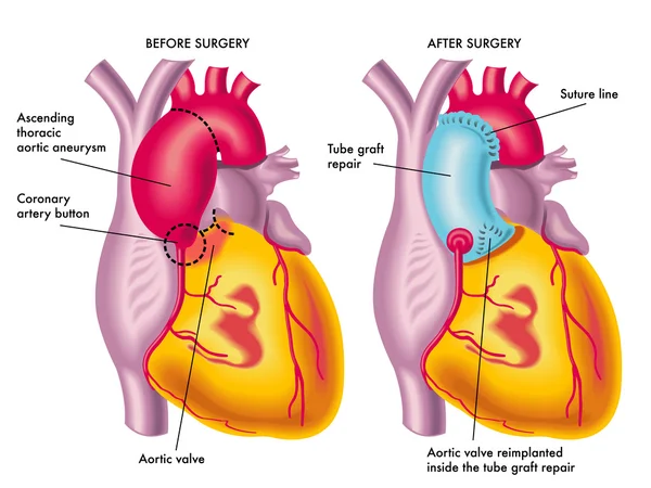 Cirugía de aneurisma aórtico torácico — Archivo Imágenes Vectoriales