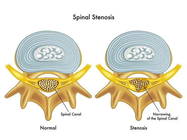 Medicinsk illustration av effekterna av spinal stenos — Stock vektor