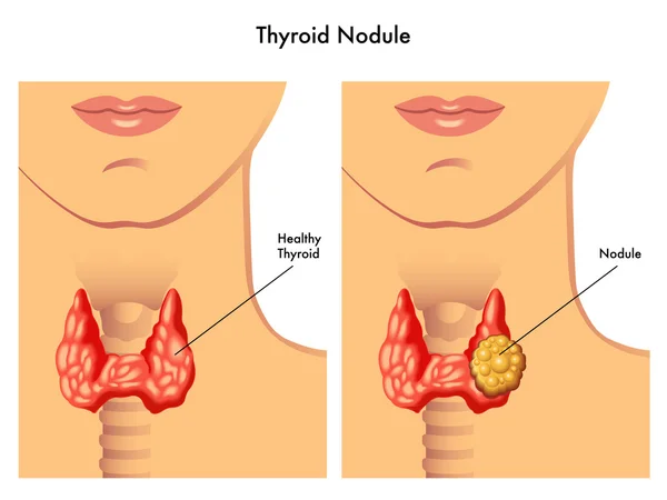 Medical illustration of the effects of the thyroid cancer — Stock Vector