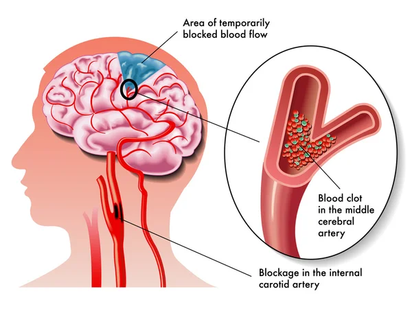 Effects of the TIA (transient ischemic attack) — Stock Vector