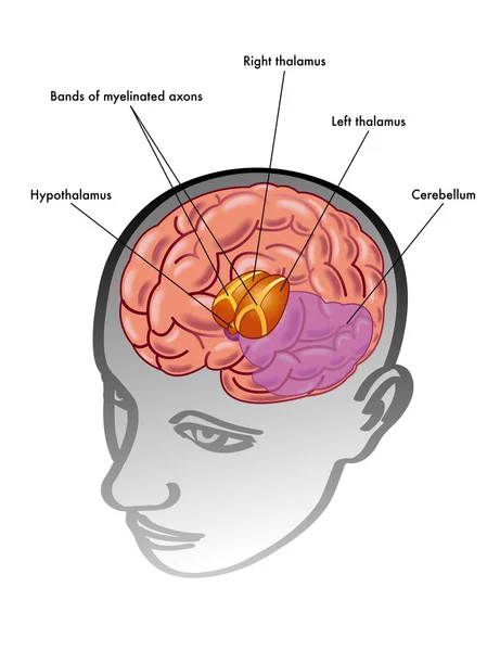 Thalamus and hypothalamus and their position inside the head — Stock Vector
