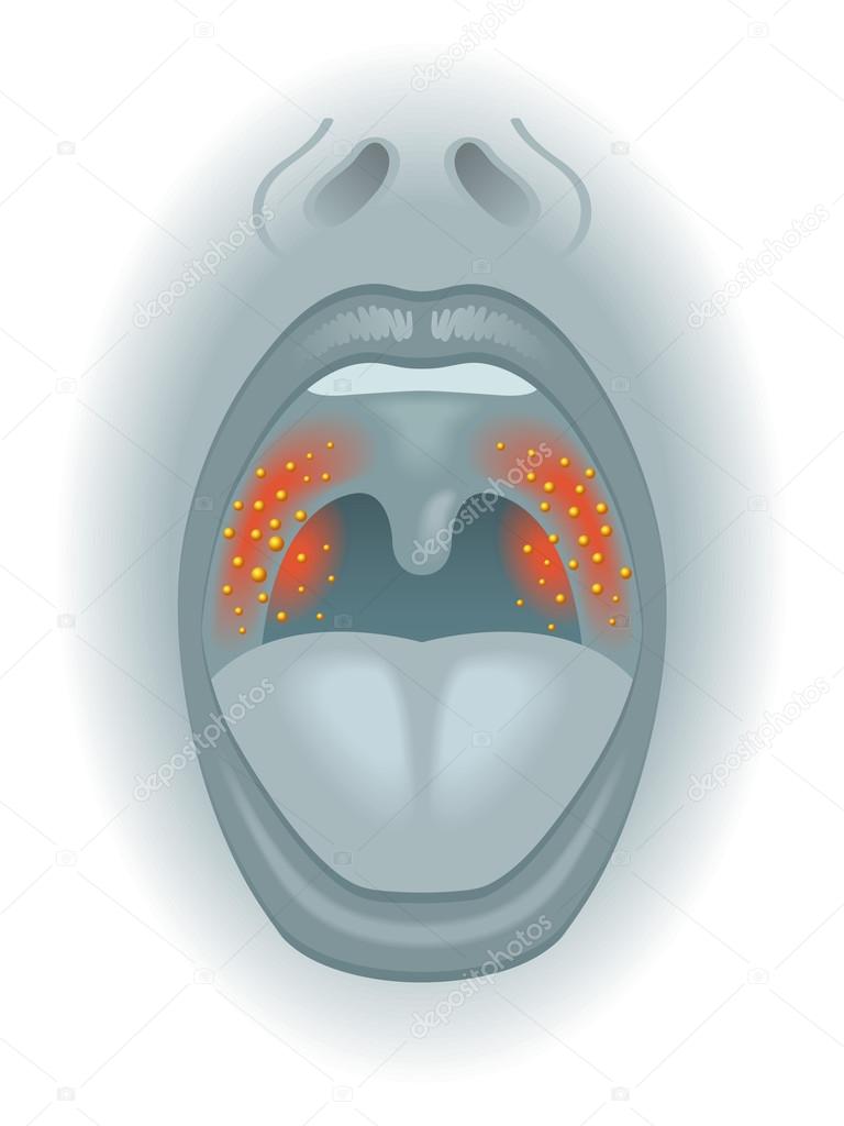 Medical illustration of the effects of sore throat