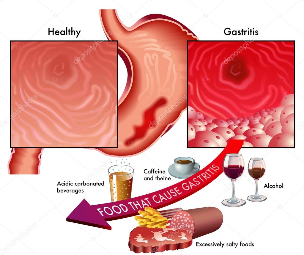 symptoms of gastritis and foods to avoid