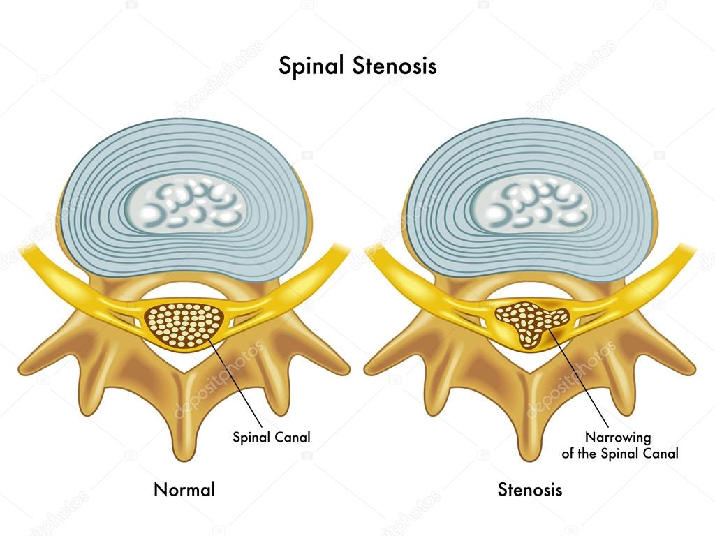Medical illustration of the effects of spinal stenosis