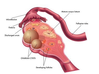 ovarian cyst and its position clipart