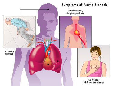 symptoms of aortic stenosis clipart
