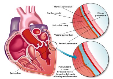 Medical illustration of the symptoms of pericarditis clipart