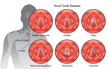 vocal cord diseases clipart
