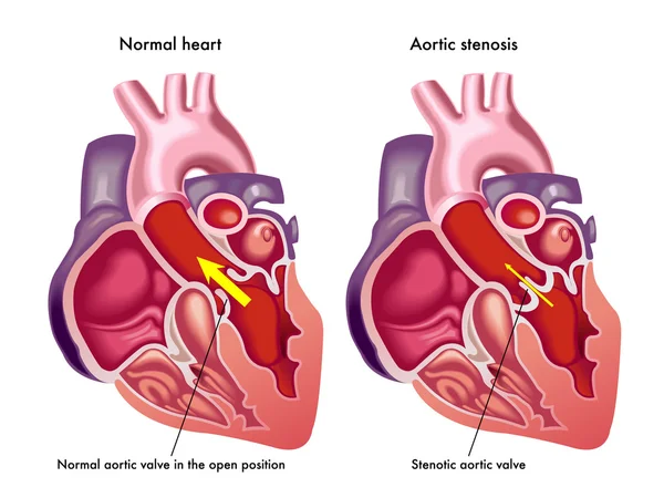 Sintomi e conseguenze del cuore congestizio — Vettoriale Stock