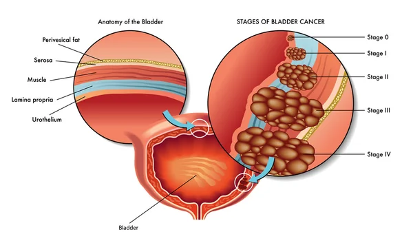 Stages of the male bladder cancer — Stock Vector