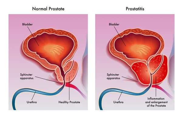 Illustrazione medica degli effetti della prostatite — Vettoriale Stock