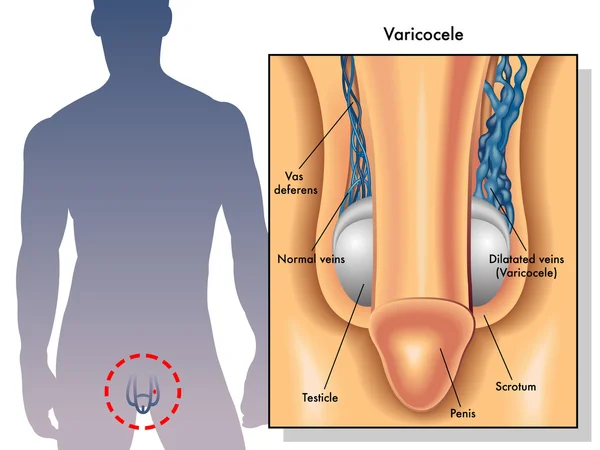 Efectos del cáncer testicular — Vector de stock