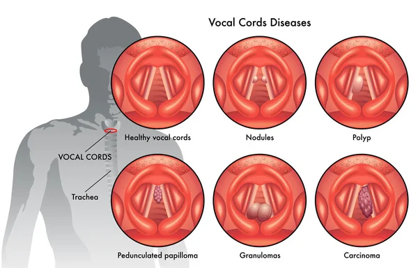 Cuerdas vocales imágenes de stock de arte vectorial | Depositphotos