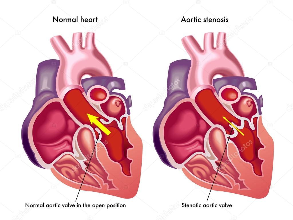 symptoms and consequences of congestive heart