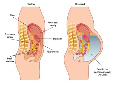 fluid in peritoneal cavity clipart