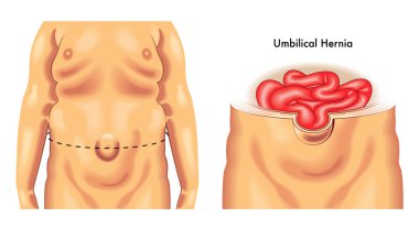 insan göbek fıtığı