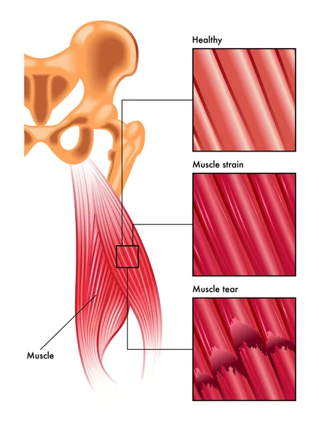 Tensión y desgarro muscular — Archivo Imágenes Vectoriales