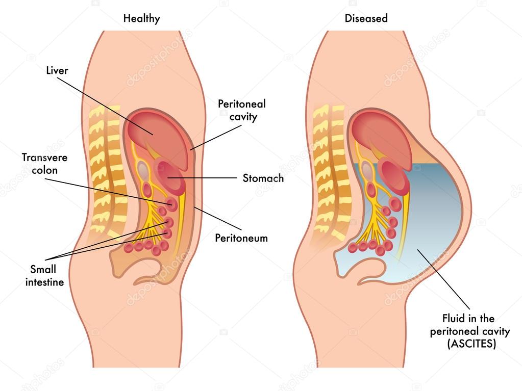 noticias-sobre-peritoneal