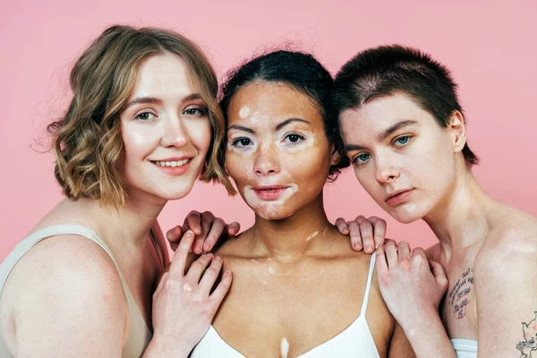 Group of multiethnic women with different kind of skin posing together in studio. Concept about body positivity and self acceptance