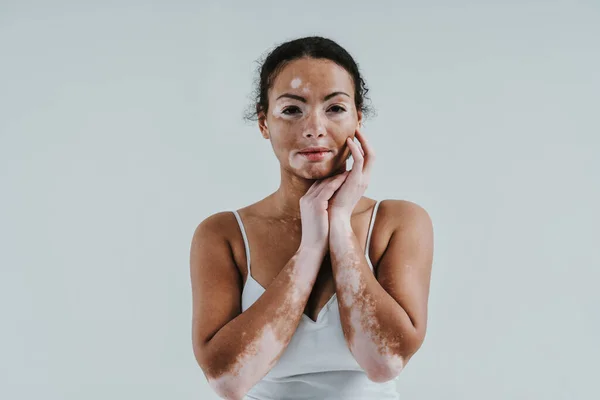 Gyönyörű Vitiligo Bőrrel Pózol Stúdióban Fogalom Test Pozitivitásáról Önelfogadottságáról — Stock Fotó