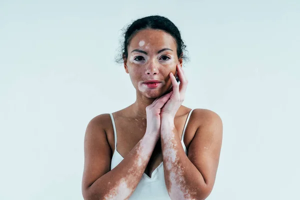 Wanita Cantik Dengan Kulit Vitiligo Berpose Studio Konsep Tentang Positif — Stok Foto