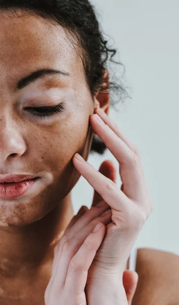 Wanita Cantik Dengan Kulit Vitiligo Berpose Studio Konsep Tentang Positif — Stok Foto