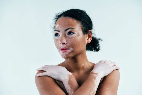Hermosa Mujer Con Piel Vitiligo Posando Estudio Concepto Sobre Positividad —  Fotos de Stock