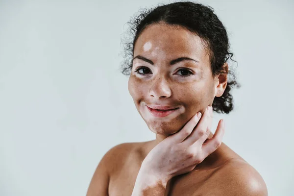 Vacker Kvinna Med Vitiligo Hud Poserar Studio Begreppet Kroppspositivitet Och — Stockfoto