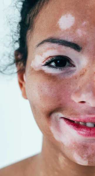 Mulher Bonita Com Vitiligo Pele Posando Estúdio Conceito Sobre Positividade — Fotografia de Stock