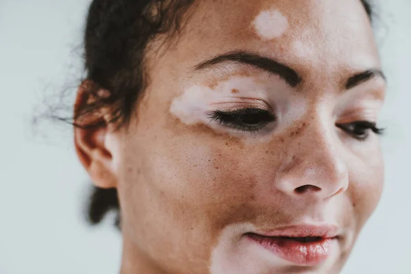 Gyönyörű Vitiligo Bőrrel Pózol Stúdióban Fogalom Test Pozitivitásáról Önelfogadottságáról — Stock Fotó