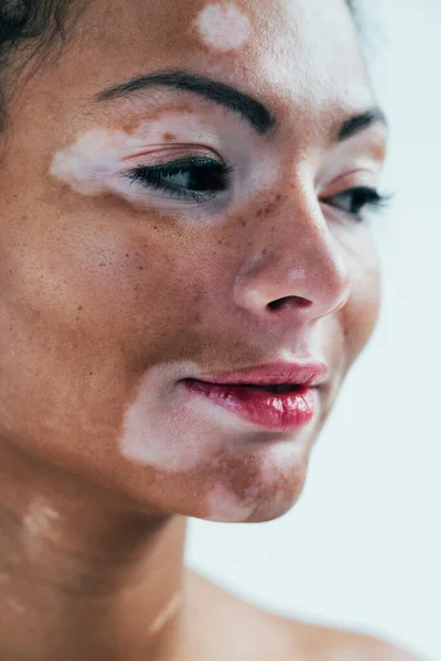 Mulher Bonita Com Vitiligo Pele Posando Estúdio Conceito Sobre Positividade — Fotografia de Stock