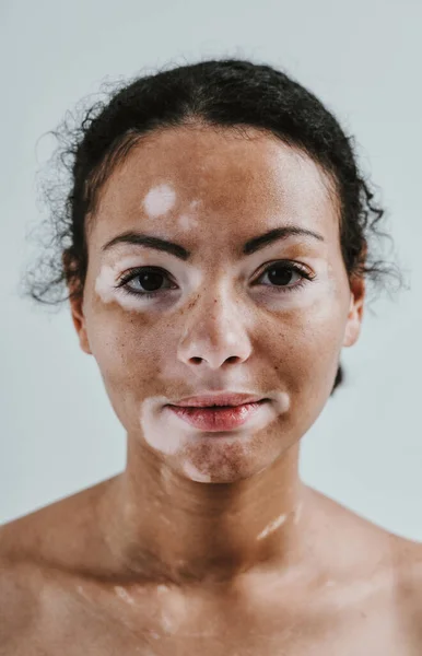 Wanita Cantik Dengan Kulit Vitiligo Berpose Studio Konsep Tentang Positif — Stok Foto