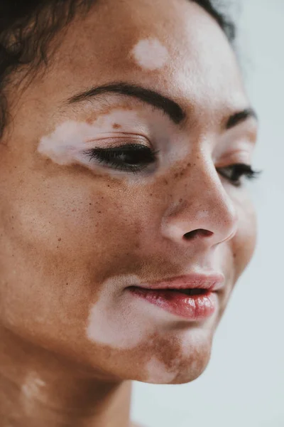 Wanita Cantik Dengan Kulit Vitiligo Berpose Studio Konsep Tentang Positif — Stok Foto