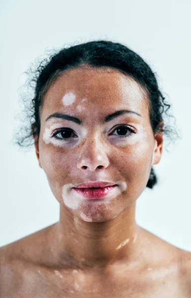 Hermosa Mujer Con Piel Vitiligo Posando Estudio Concepto Sobre Positividad — Foto de Stock