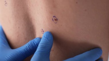 Mavi eldivenli cildiyeciler deri kanseri taraması ve estetik cerrahi muayenesi sırasında kıllı bir erkek gövdesindeki benleri inceliyor..