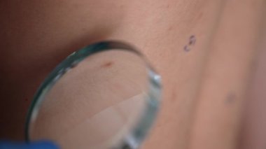 Mavi eldiven giyen bir dermatolog deri kanseri taraması ve estetik cerrahi muayenesi sırasında kıllı bir adamın sırtındaki büyüteçle beni inceliyor..