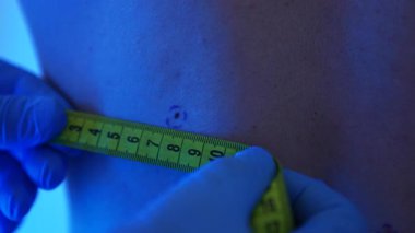Mavi eldiven giyen bir dermatolog deri kanseri taraması ve estetik cerrahi muayenesi sırasında bir adamı muayene eder ve ölçer. Bir klinikte neon mavi ışık.