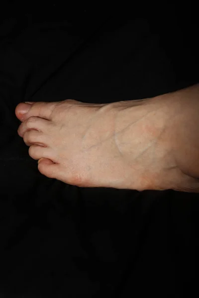 Foot Large Veins Crooked Pinky Toe — Stock Photo, Image