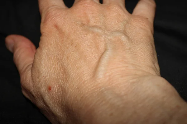 Enlarged Veins Back Woman Right Hand — Stock Photo, Image