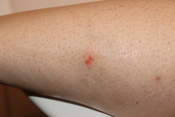 Snake bite on the back of a woman\'s leg.
