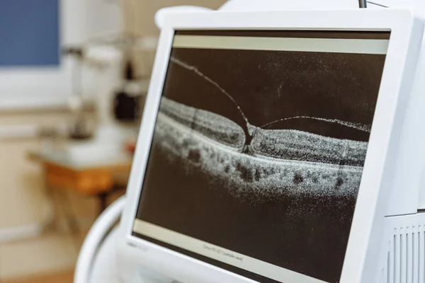 Göz küresinin ön ve arka bölümlerinin görselleştirilmesi için optik tutarlılık tomografisi. Tıbbi ekipman